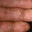 3. Eczema Between Fingers Pictures