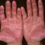 32. Eczema Between Fingers Pictures