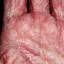 35. Eczema Between Fingers Pictures