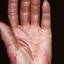 37. Eczema Between Fingers Pictures