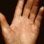 40. Eczema Between Fingers Pictures