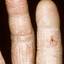 41. Eczema Between Fingers Pictures