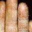 43. Eczema Between Fingers Pictures