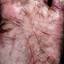 44. Eczema Between Fingers Pictures