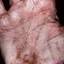 49. Eczema Between Fingers Pictures