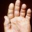 51. Eczema Between Fingers Pictures