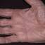 54. Eczema Between Fingers Pictures