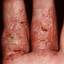 55. Eczema Between Fingers Pictures