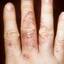 56. Eczema Between Fingers Pictures