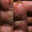 64. Eczema Between Fingers Pictures