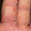 68. Eczema Between Fingers Pictures
