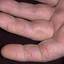 7. Eczema Between Fingers Pictures