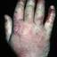 70. Eczema Between Fingers Pictures