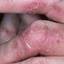 76. Eczema Between Fingers Pictures