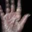 81. Eczema Between Fingers Pictures