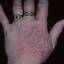 86. Eczema Between Fingers Pictures
