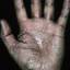 92. Eczema Between Fingers Pictures