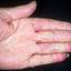 98. Eczema Between Fingers Pictures