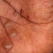 Dry Eczema on Hands