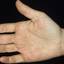 102. Dry Eczema on Hands Pictures