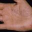 105. Dry Eczema on Hands Pictures