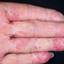 107. Dry Eczema on Hands Pictures