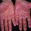108. Dry Eczema on Hands Pictures