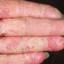 111. Dry Eczema on Hands Pictures