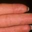 114. Dry Eczema on Hands Pictures