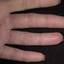 115. Dry Eczema on Hands Pictures