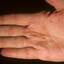 122. Dry Eczema on Hands Pictures