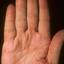 123. Dry Eczema on Hands Pictures