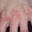 125. Dry Eczema on Hands Pictures