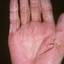 128. Dry Eczema on Hands Pictures