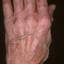 130. Dry Eczema on Hands Pictures