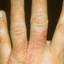 138. Dry Eczema on Hands Pictures