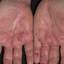 147. Dry Eczema on Hands Pictures