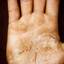 149. Dry Eczema on Hands Pictures