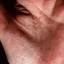 152. Dry Eczema on Hands Pictures