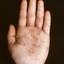 153. Dry Eczema on Hands Pictures