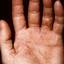 156. Dry Eczema on Hands Pictures