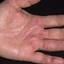 158. Dry Eczema on Hands Pictures