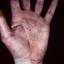 165. Dry Eczema on Hands Pictures