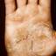 171. Dry Eczema on Hands Pictures