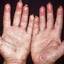 174. Dry Eczema on Hands Pictures