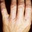 175. Dry Eczema on Hands Pictures