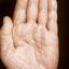177. Dry Eczema on Hands Pictures