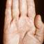 178. Dry Eczema on Hands Pictures