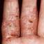 179. Dry Eczema on Hands Pictures