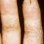 184. Dry Eczema on Hands Pictures